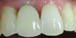 After: Dental Implant