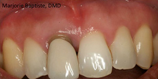 Before: Dental Implant